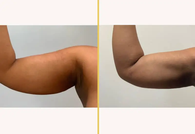 Illuum liposuction female arm