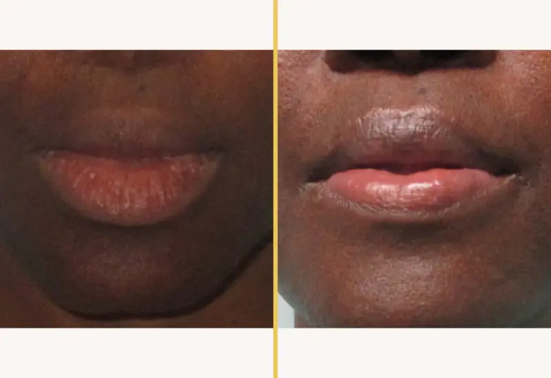 Lip reduction on male