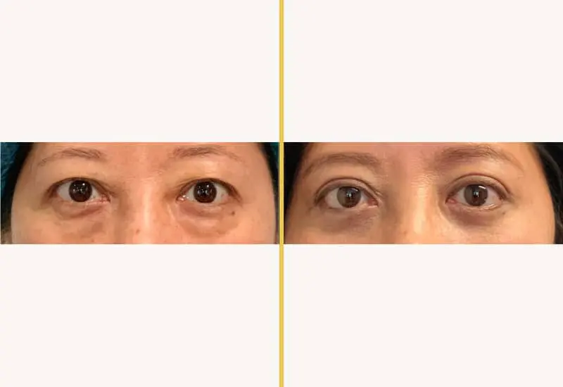 eyelid surgery 224 main