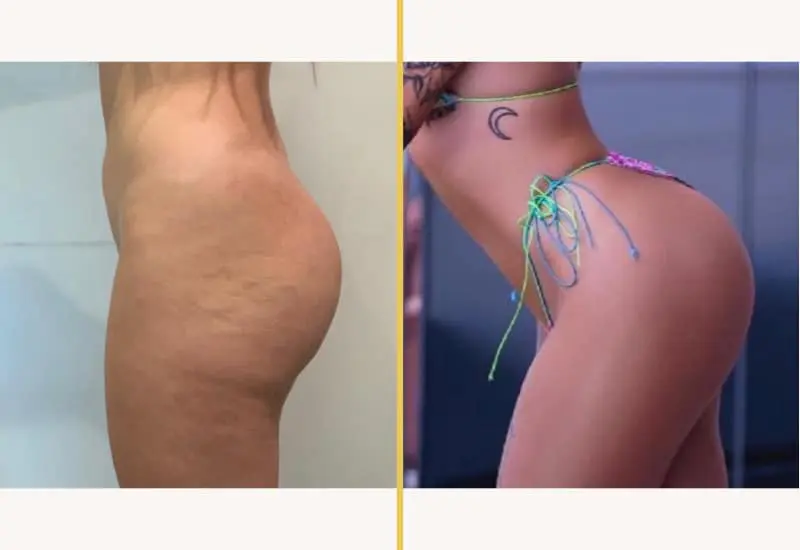Brazilian Butt Lift on female