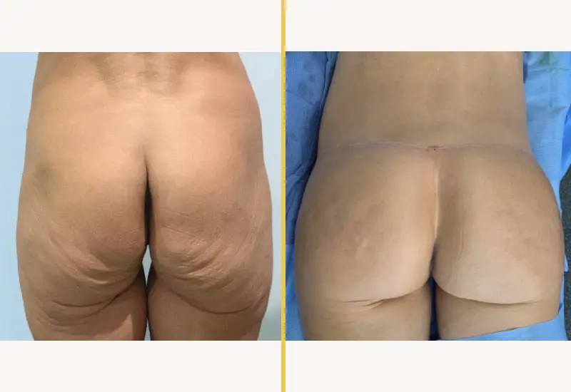 Illuum Brazilian Butt Lift on female