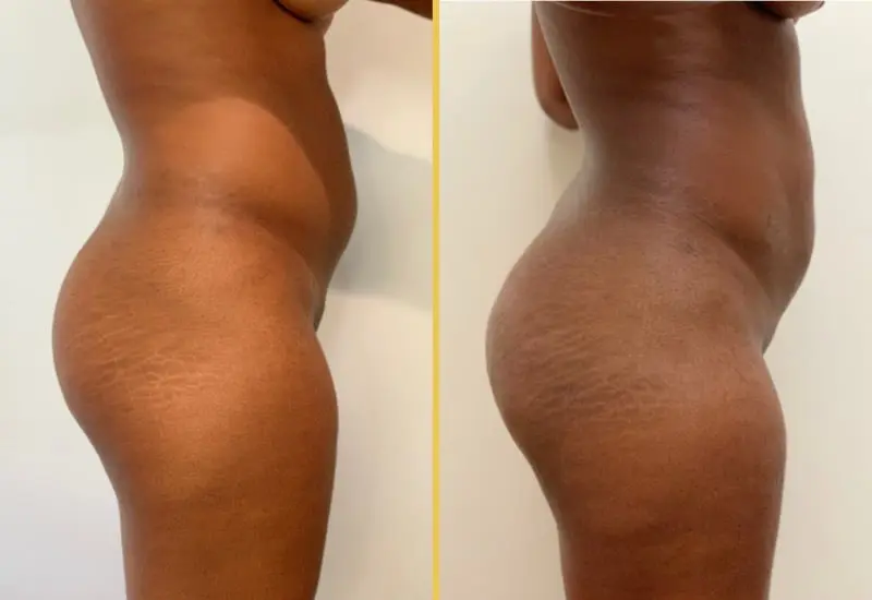 Brazilian Butt Lift female