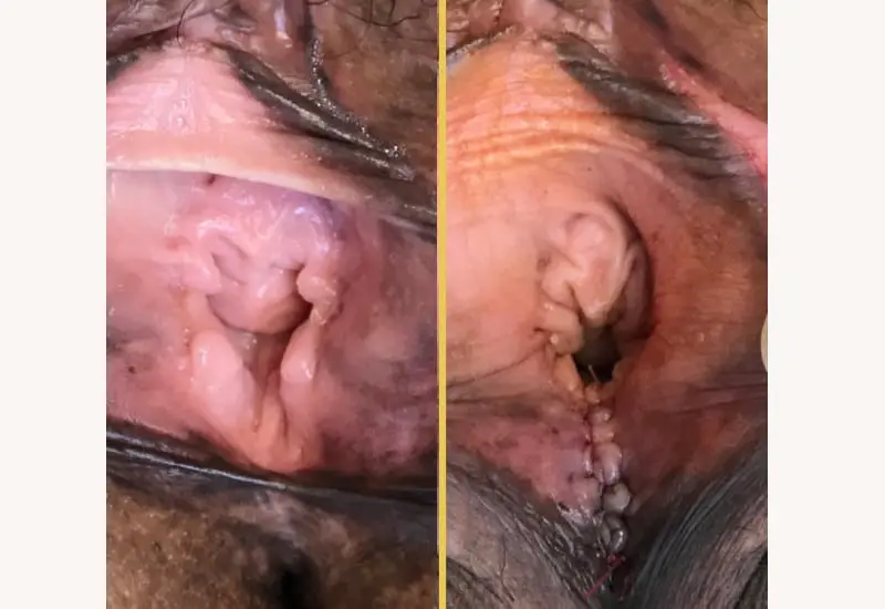 Illuum Vaginal Rejuvenation