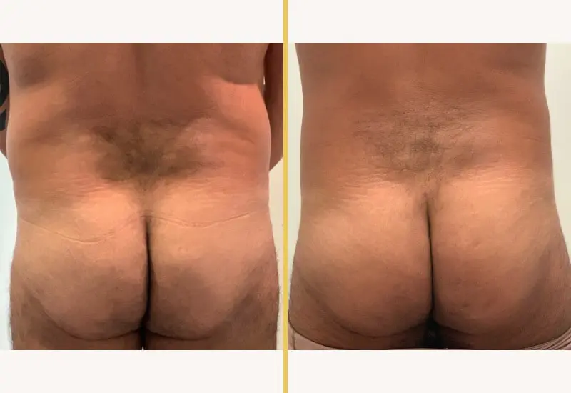 Brazilian Butt Lift on male