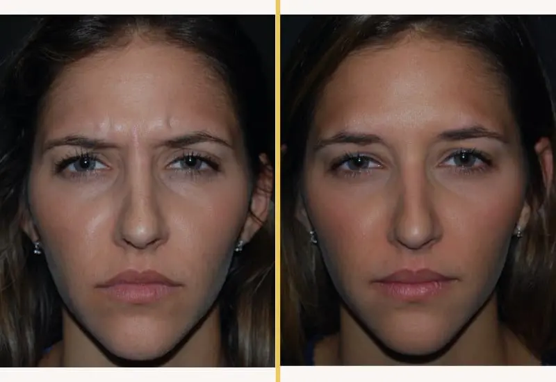 Illuum botox before and after