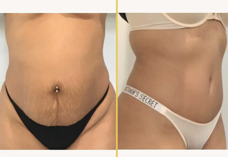 tummy tuck with ab silh 1