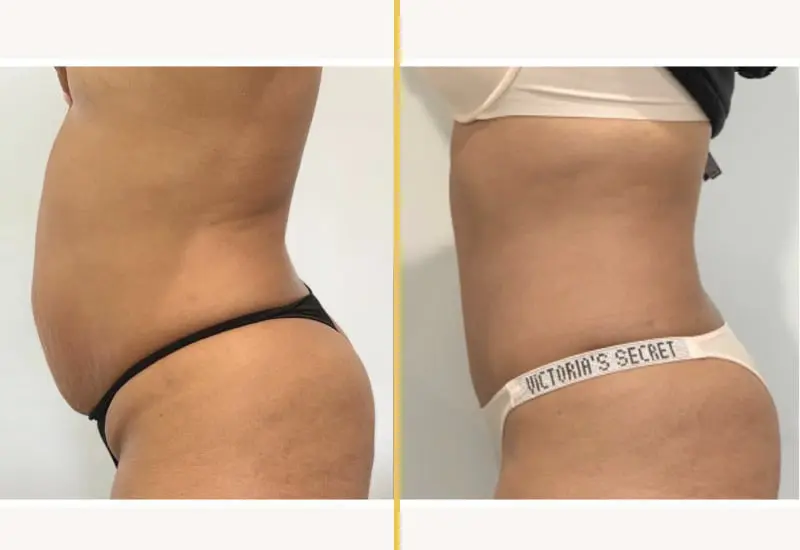 tummy tuck with ab silh 8