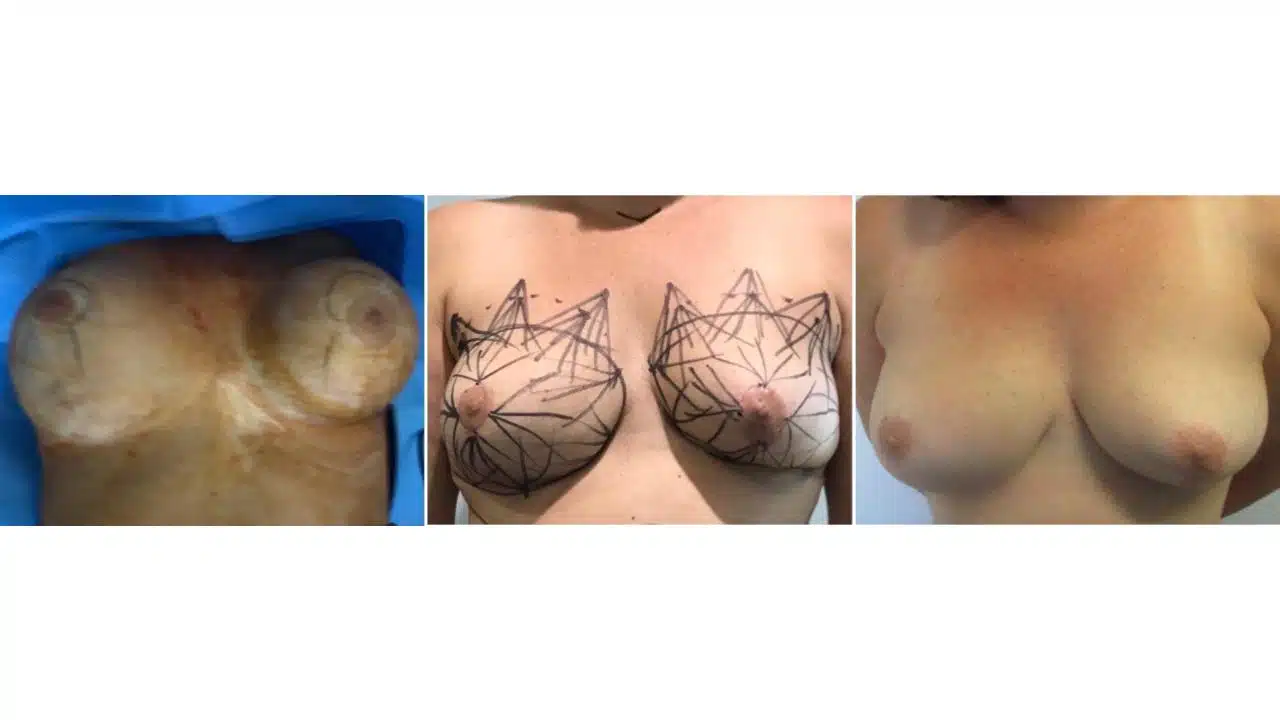 Breast Augmentation with Fat Transfer.pptx