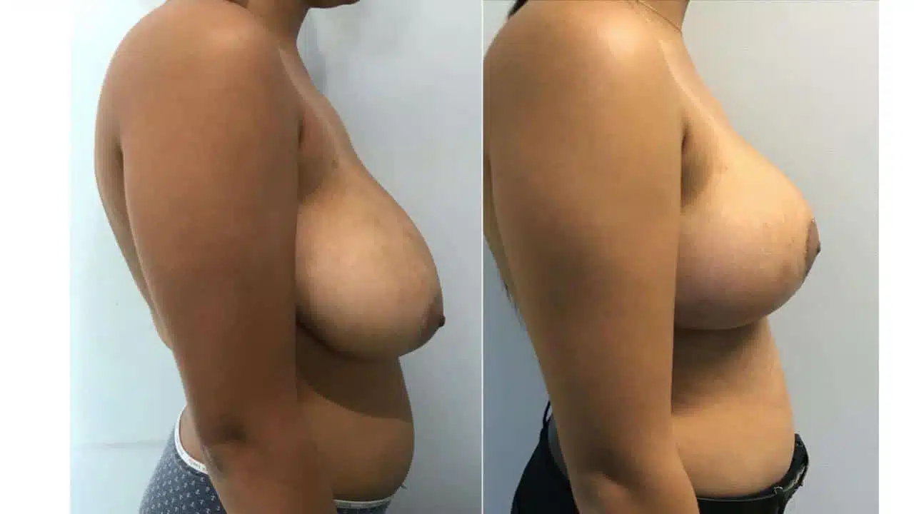 Breast Reduction.pptx 28