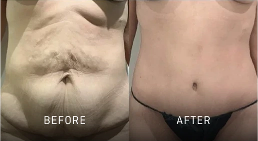 Before & After Gallery Tummy Tuck Banner