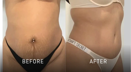 Before & After Gallery Tummy Tuck Banner