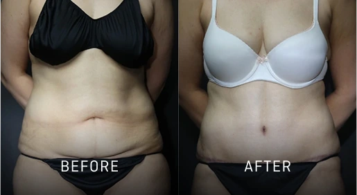 Before & After Gallery Tummy Tuck Banner