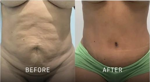 Before & After Gallery Tummy Tuck Banner