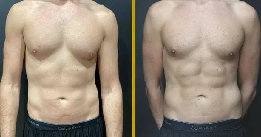 Before and After Gallery: Male Ab-Etching