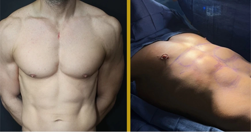 Before and After Gallery: Male Ab-Etching