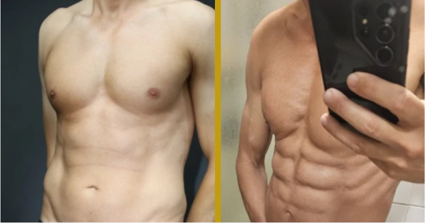 Before and After Gallery: Male Ab-Etching