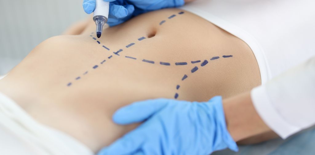 How Does Liposuction Work?