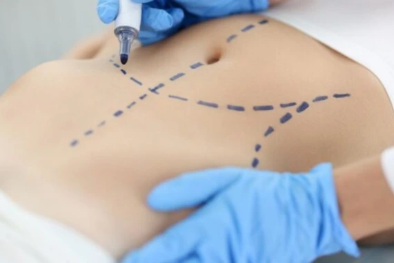 How Does Liposuction Work?