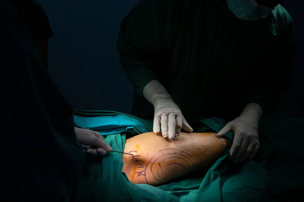 Does Liposuction Leave Scars? What to Expect and How to Manage Them Banner