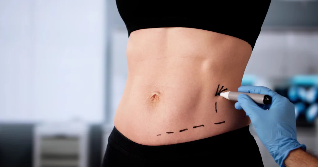Is Liposuction Permanent? Understanding Long-Term Results and Effects Banner