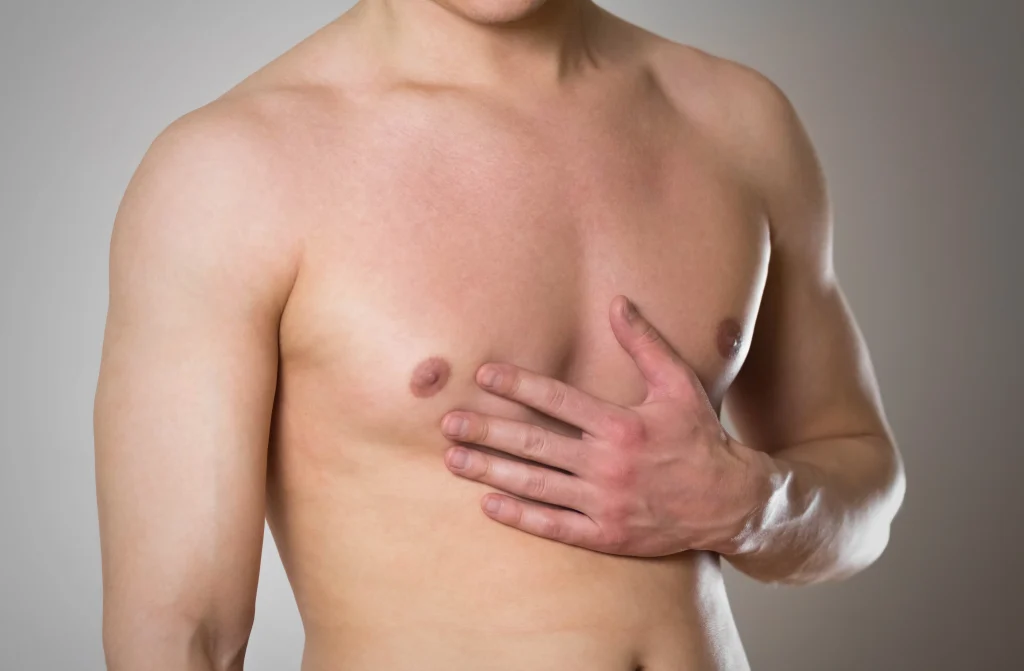 How to Reduce Gynecomastia Surgery Scar Visibility? banner