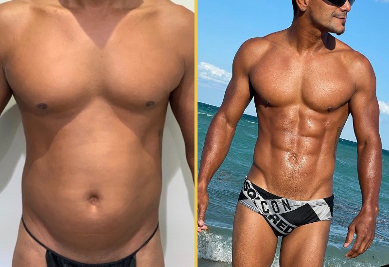 Before and After Gallery: Gynecomastia