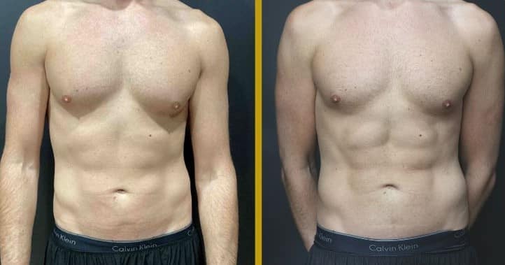 Before and After Gallery: Gynecomastia