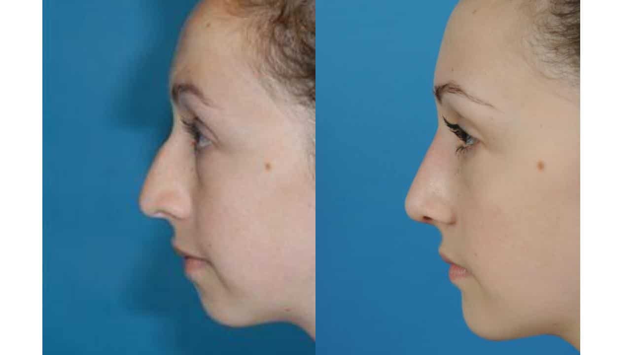Before and After Gallery: Rhinoplasty