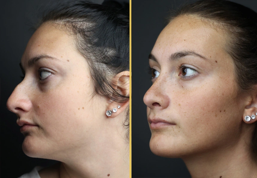 Before and After Gallery: Rhinoplasty