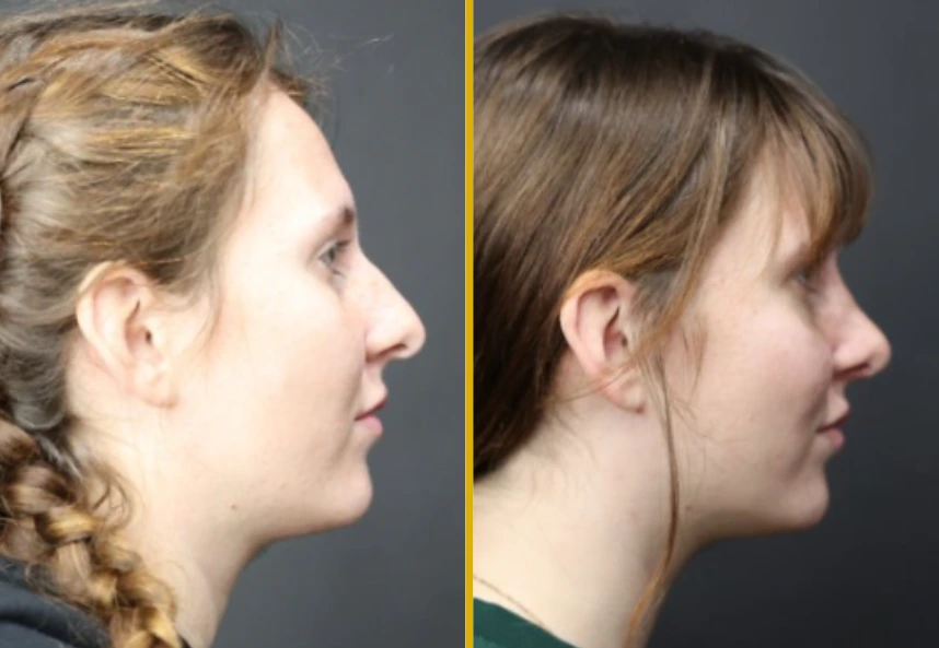 Before and After Gallery: Rhinoplasty