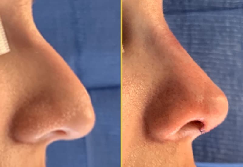 Before and After Gallery: Rhinoplasty